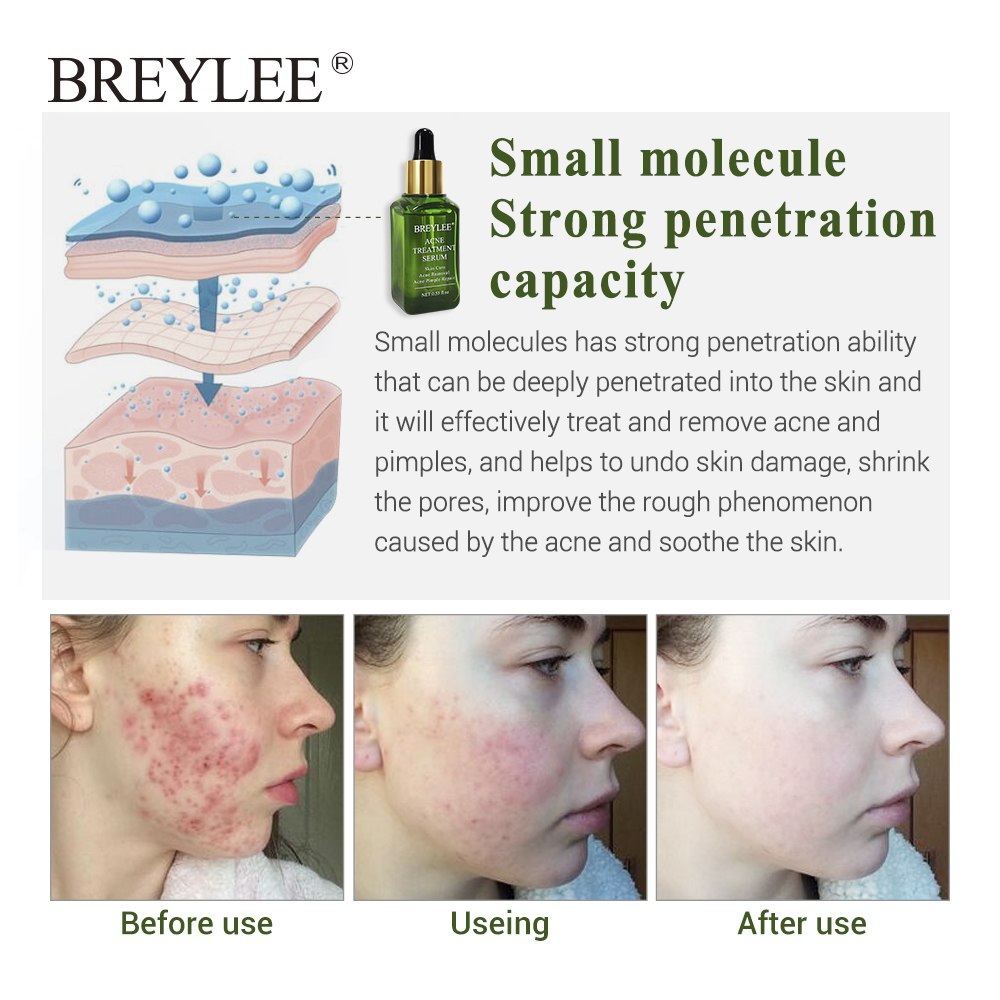 Acne-No-More — Breylee Anti-Acne Treatment Serum