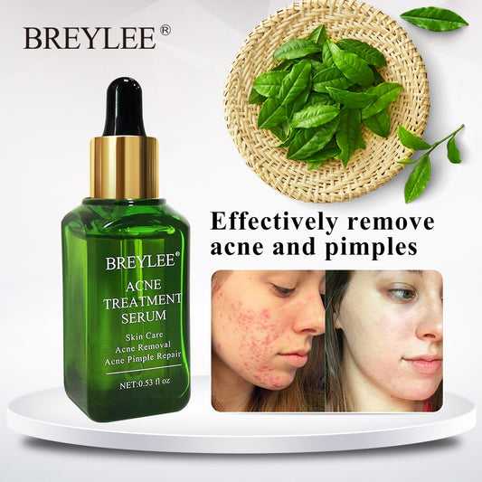 Acne-No-More — Breylee Anti-Acne Treatment Serum
