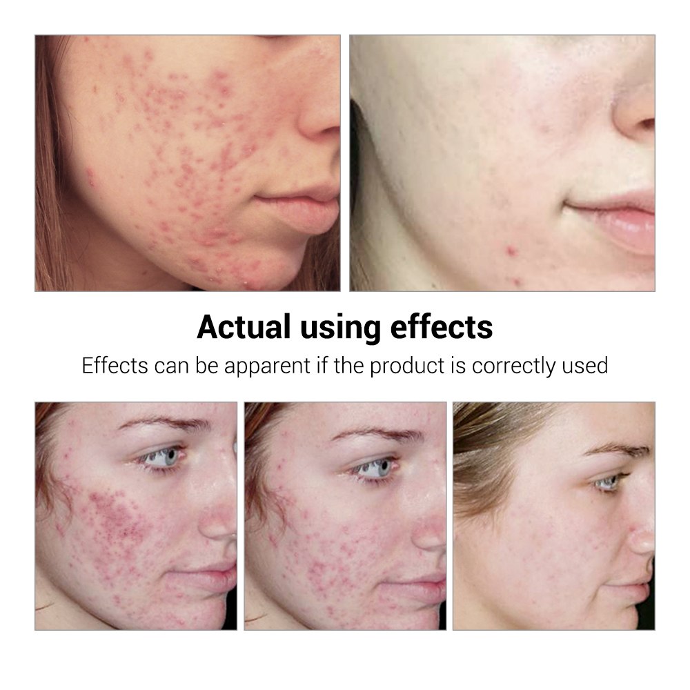 Acne-No-More — Breylee Anti-Acne Treatment Serum