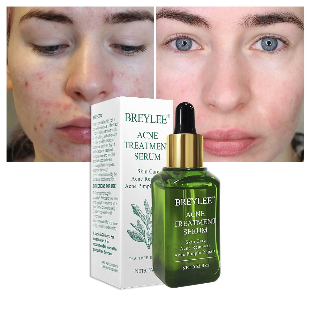 Acne-No-More — Breylee Anti-Acne Treatment Serum